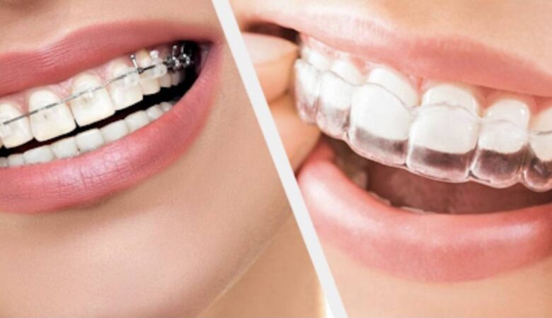 Orthodontics Braces: Understanding How Lifestyle Choices Impact